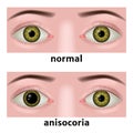 anisocoria. abnormally dilated pupil of the eye.
